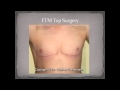 FTM Top Surgery - Dr. Charles Garramone
