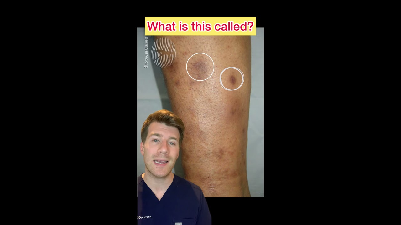 Brown Patches On The Shins In A Diabetic Patient What S Diagnosis Shorts Medical Diabetes