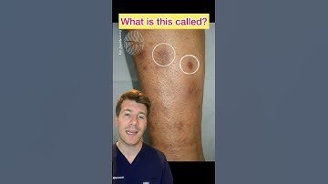 Brown patches on the shins in a diabetic patient … what’s the diagnosis? #shorts #medical #diabetes