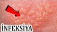 Видео по запросу "cinsi infeksiya dermanlari"