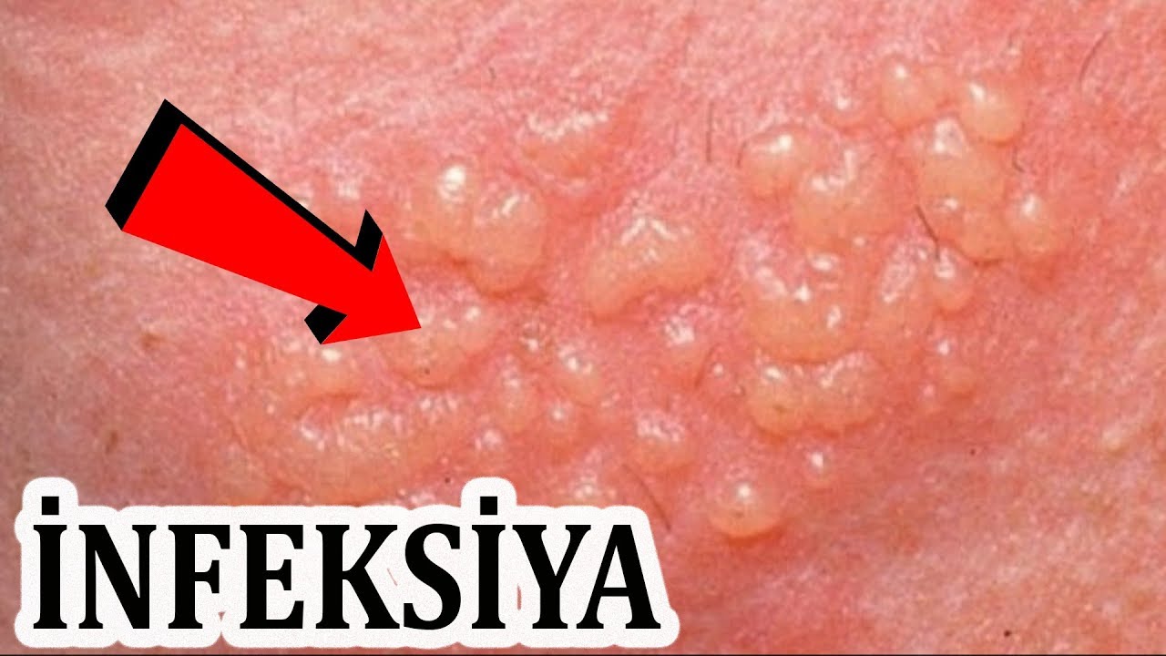 hpv humán papillomavírus anogenitális fertőzés féreg szabványok