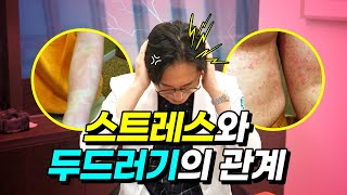 만성 두드러기에 영향을 미치는 스트레스와 그 관리법