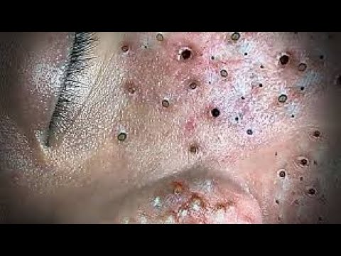 Toltal Best blackheads by Loan Nguyen, No ads