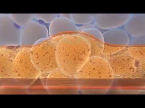 ზელტიკი - ცხიმების მოყინვით დაშლა კლინიკა მედიში