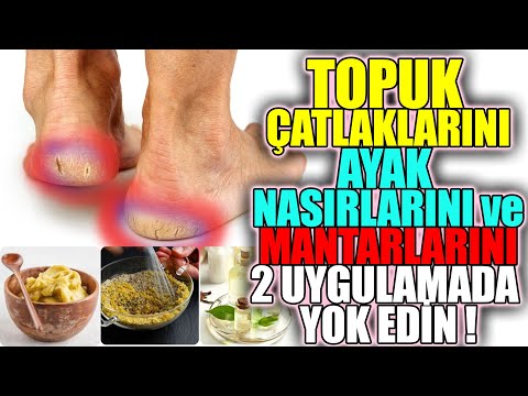 Topuk Çatlağı El Nasırları 2 Günde Yok Eden Yöntem