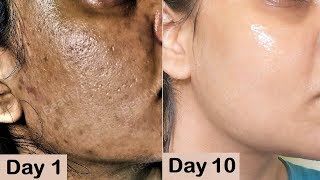 Repair Damaged Skin - Close Large OPEN PORES & Remove Dark spots, Hyper pigmentation with Potato screenshot 2