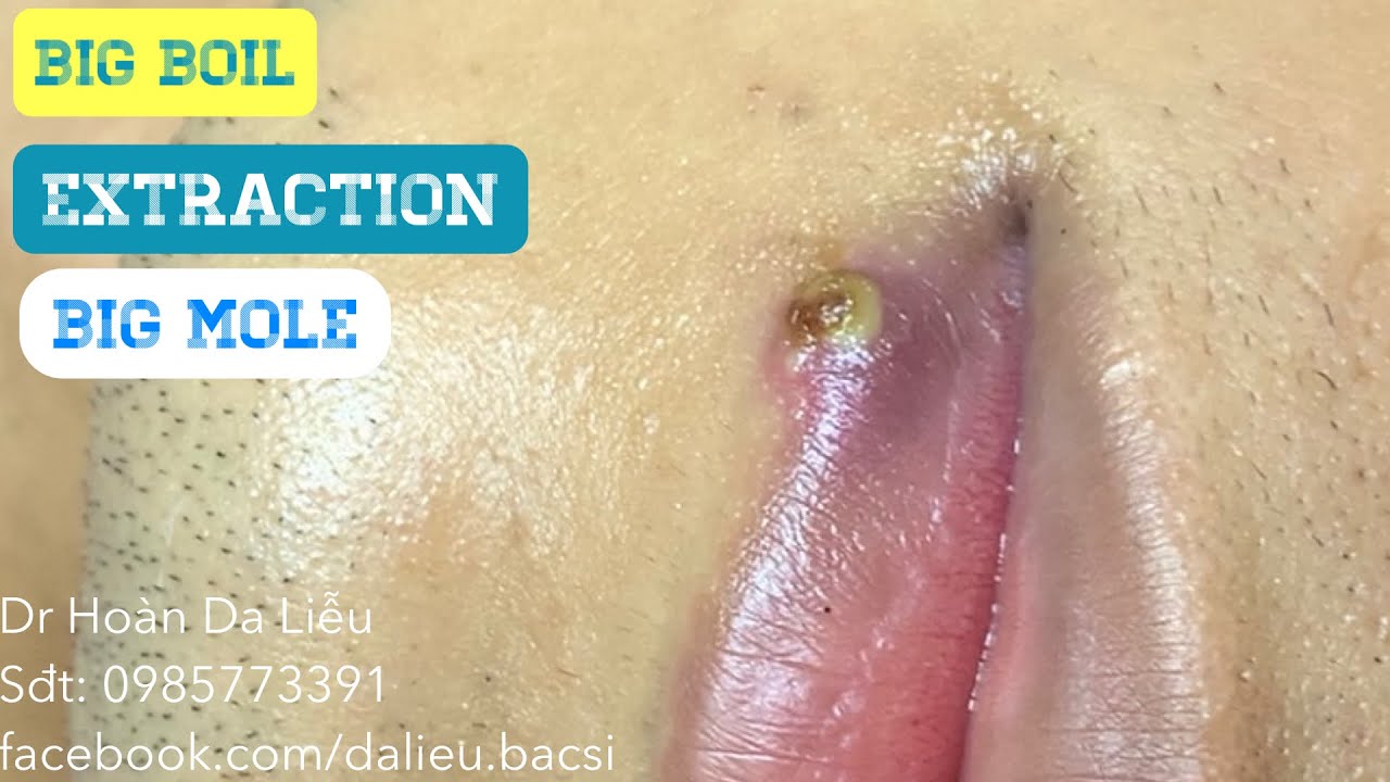 Chích cái nhọt môi,tẩy nốt ruồi trâu|Dermatologist, pimples,whitehead blackhead, big boil extraction