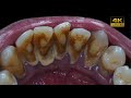 32 yo males teeth  karang gigi  dentist  dokter gigi tri putra