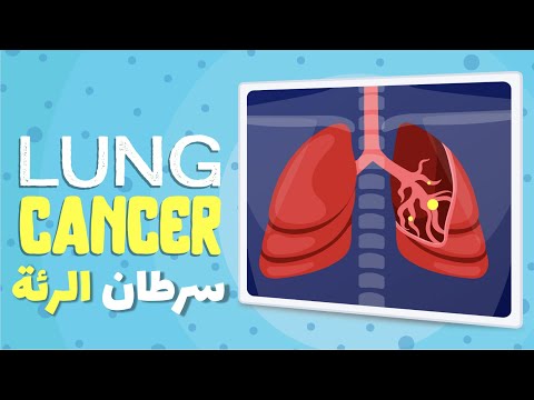 فيديو: كيفية الكشف عن سرطان الرئة: 12 خطوة (بالصور)