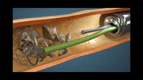 Cirugía de Cálculo de Ureter