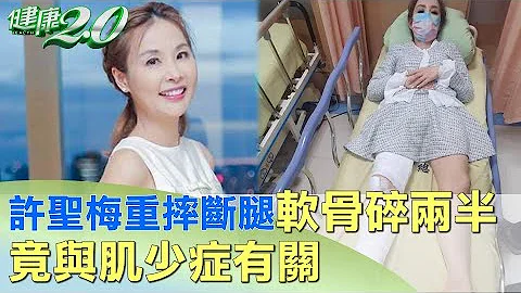 许圣梅意外重摔断腿软骨碎两半 竟与肌少症有关 健康2.0 - 天天要闻