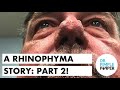 A Rhinophyma Story: Part 2