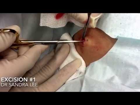 Excision Of Abdominal Lipoma #1: For Medical Education- NSFE.