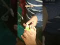 अग्निकर्म | शल्य तंत्र