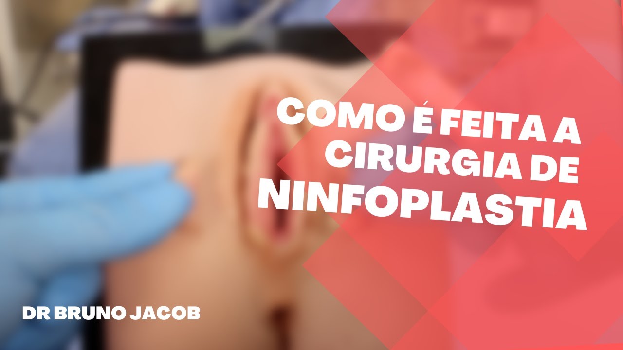 COMO É FEITA A CIRURGIA DE NINFOPLASTIA A LASER? - YouTube