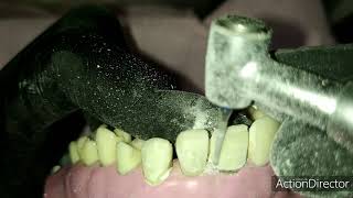 PFM ceramometalic restoration  upper central incisor عربي