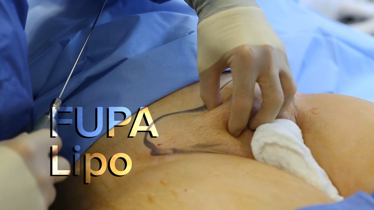 Liposuction of the FUPA (Mons)