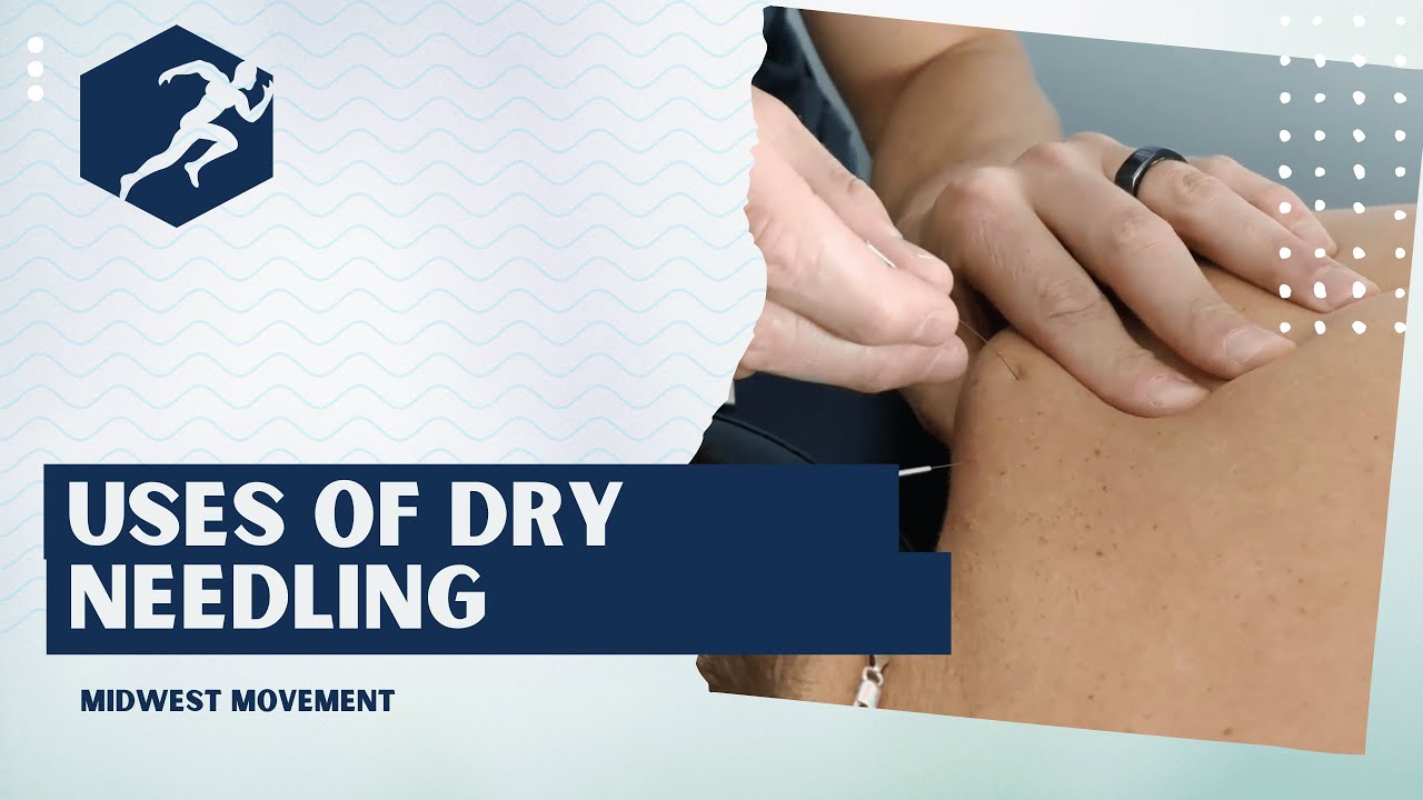 Uses of Dry Needling / Midwest Movement - YouTube