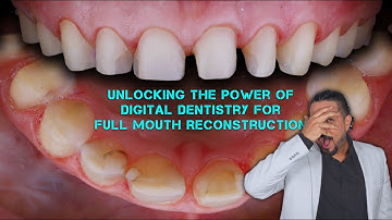 Unlocking the Power of Digital Dentistry for Full Mouth Reconstruction I Case in Full Protocol