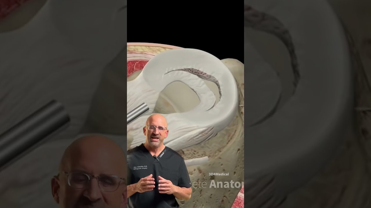 Knee Locked Up Bucket Handle Meniscus Tear Explained Surgery