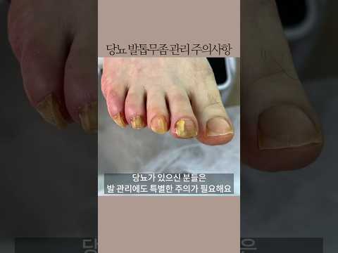 #당뇨발톱 무좀발톱이 더 심해지는거 같아요#레푸스화정점 #레푸스 shorts#refuss #당뇨발#발톱관리#발톱무좀