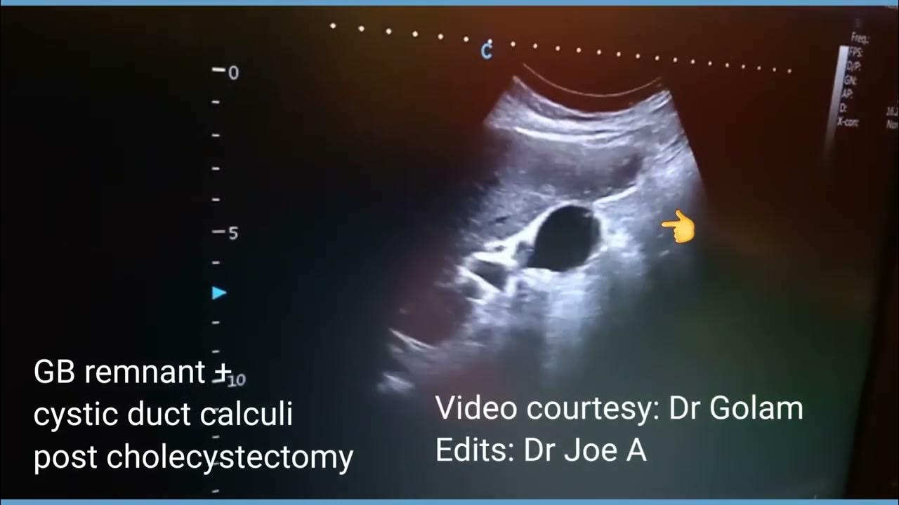 post-cholecystectomy-calculi-in-gallbladder-remnant-stump-and-cystic