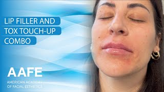 Lip Filler and Tox Touch-Up Combo