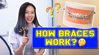 HOW Braces WORK? | #BraceYourself!