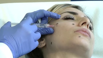 PROFHILO   BAP TECHNIQUE