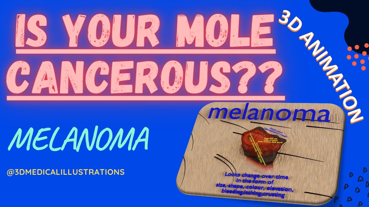 skin cancer - mole benign versus malignant melanoma - cancerous moles ...