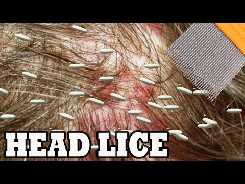 What are Super Lice?  Super, Super Lice Facts!  👍❓👍❓