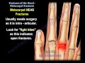 Metacarpal Fractures - Everything You Need To Know - Dr. Nabil Ebraheim