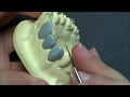 Live wax up  upper canine