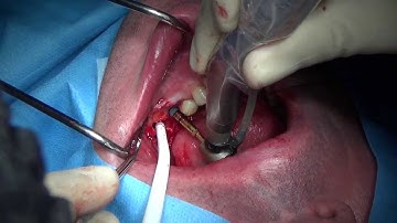 Immediate implant placement in mandibular molar extraction socket.