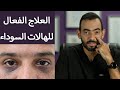 أنواع الهالات السوداء والعلاجات الفعالة