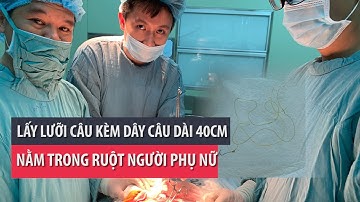 Lưỡi câu kèm dây câu dài 40 cm nằm trong ruột người phụ nữ- PLO