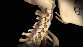 Neck Surgery | Cervical Disc Replacement | Nucleus Health