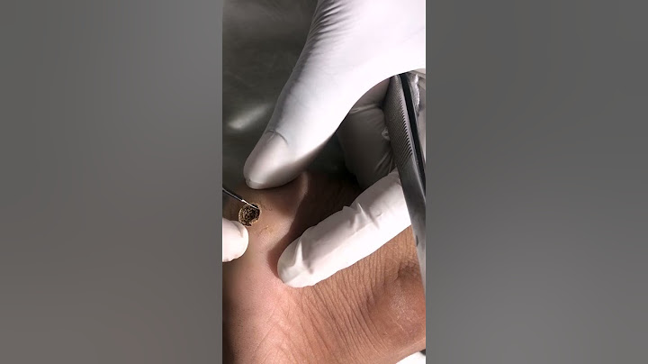 Warts Removal Treatment | Safe and Effective Wart Removal Treatment | Skinaa Clinic #viral #ytshorts