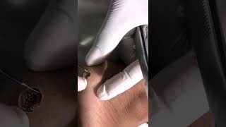 Warts Removal Treatment Safe And Effective Wart Removal Treatment Skinaa Clinic 