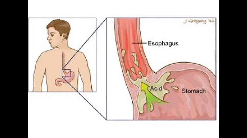 Желудочный сок в пищеводе