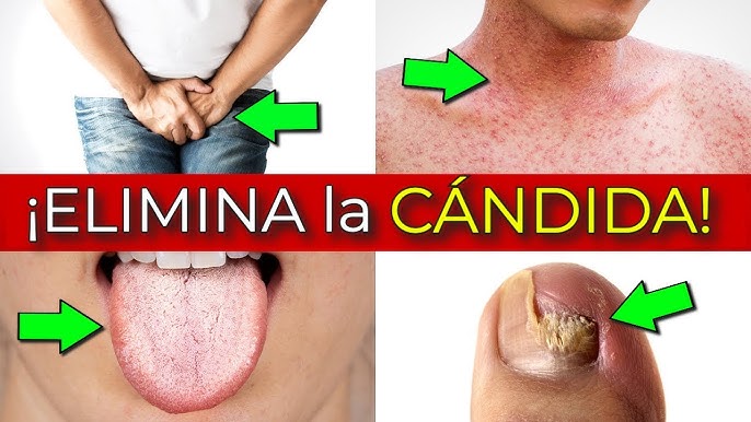 Eliminate CANDIDA MUSHROOM from your Body | Diet and Natural Remedies to  Cure Candidiasis - YouTube