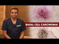 Basal cell carcinoma  dr sree charan