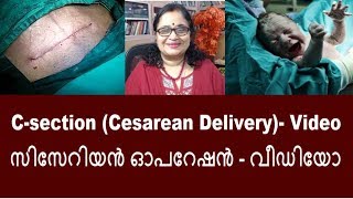 C-Section (Cesarean Delivery)-Video With Narration (മലയാളം)