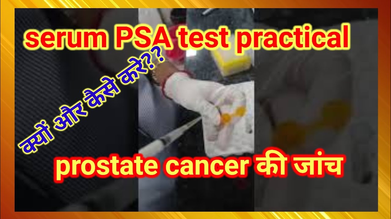 PSA test procedure//prostate cancer,prostate cancer (disease or medical ...