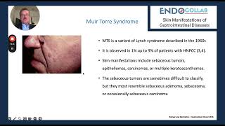 Gardner's Syndrome and Muir Torre Syndrome: A Rare Genetic Mutation with Skin Manifestations