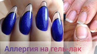 УЖАС😭 АЛЛЕРГИЯ НА ГЕЛЬ-ЛАК😱ЧТО ДЕЛАТЬ🤷КАК ИЗБЕЖАТЬ💅 ХРУСТАЛЬНЫЙ ФРЕНЧ💙МАНИКЮР/НАРАЩИВАНИЕ САМА СЕБЕ🤦