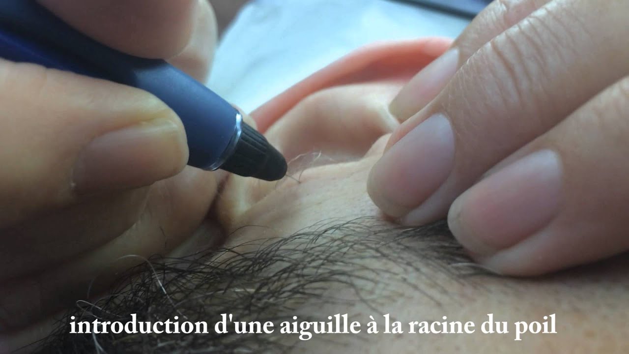 Epilation électrique définitive des poils des oreilles - YouTube