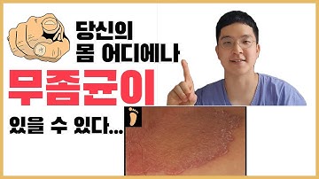 피부과의사가 말해주는 곰팡이 핵심정리, 백선증, 피부진균증, 무좀 [피부의 모든 것 덤덤 TV]