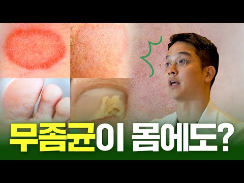 피부과의사가 말해주는 곰팡이 핵심정리, 백선증, 피부진균증, 무좀 [피부의 모든 것 덤덤 TV]