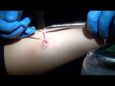 Video: 3 Mga Paraan upang Pagalingin ang Mga Implant ng Dibdib